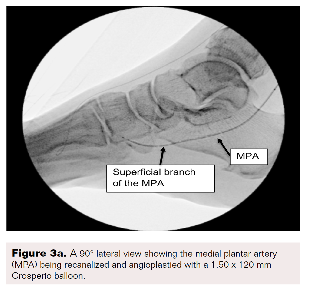 PedalPlantar Loop in Lower Extremity Angiographic Interventions